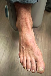 Wstydliwe choroby stóp: Bolesne nagniotki (2)